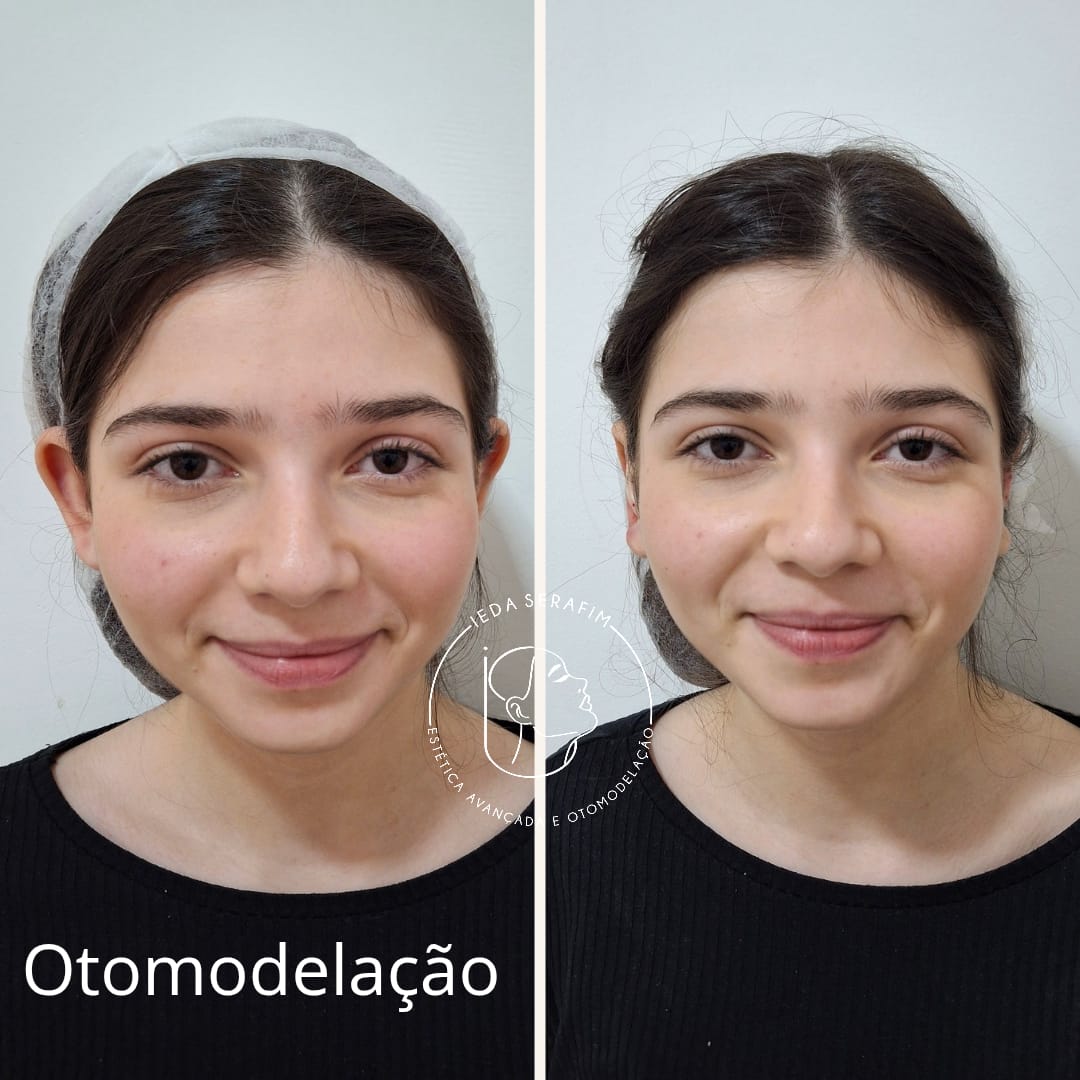Antes e depois de otomodelação — resultado 4