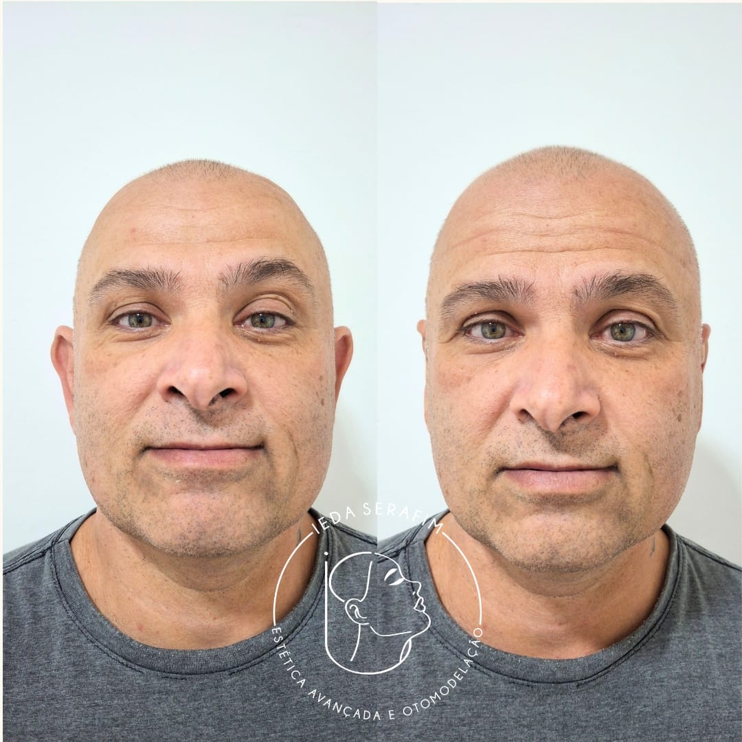 Antes e depois de otomodelação — resultado 6
