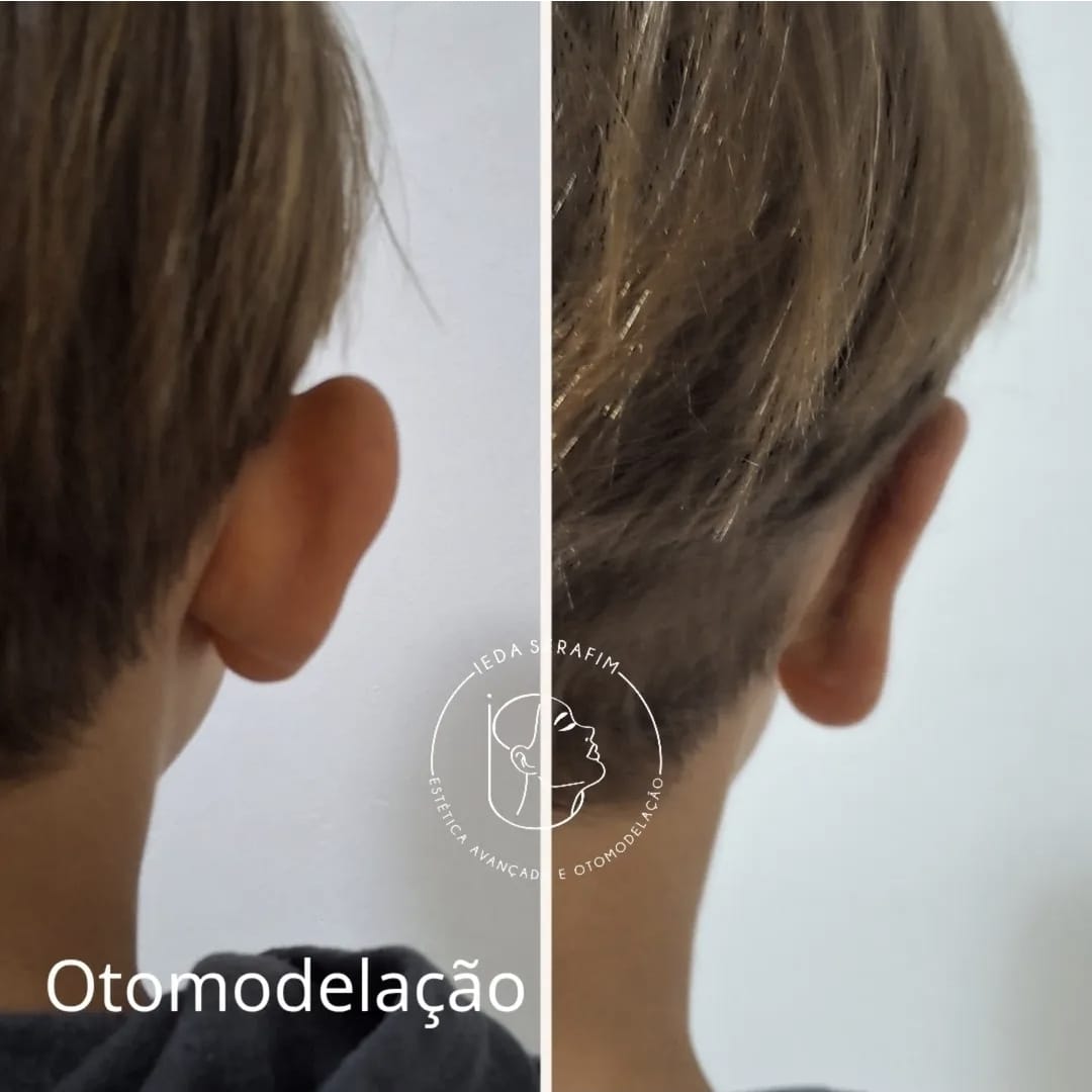 Antes e depois de otomodelação — resultado 7
