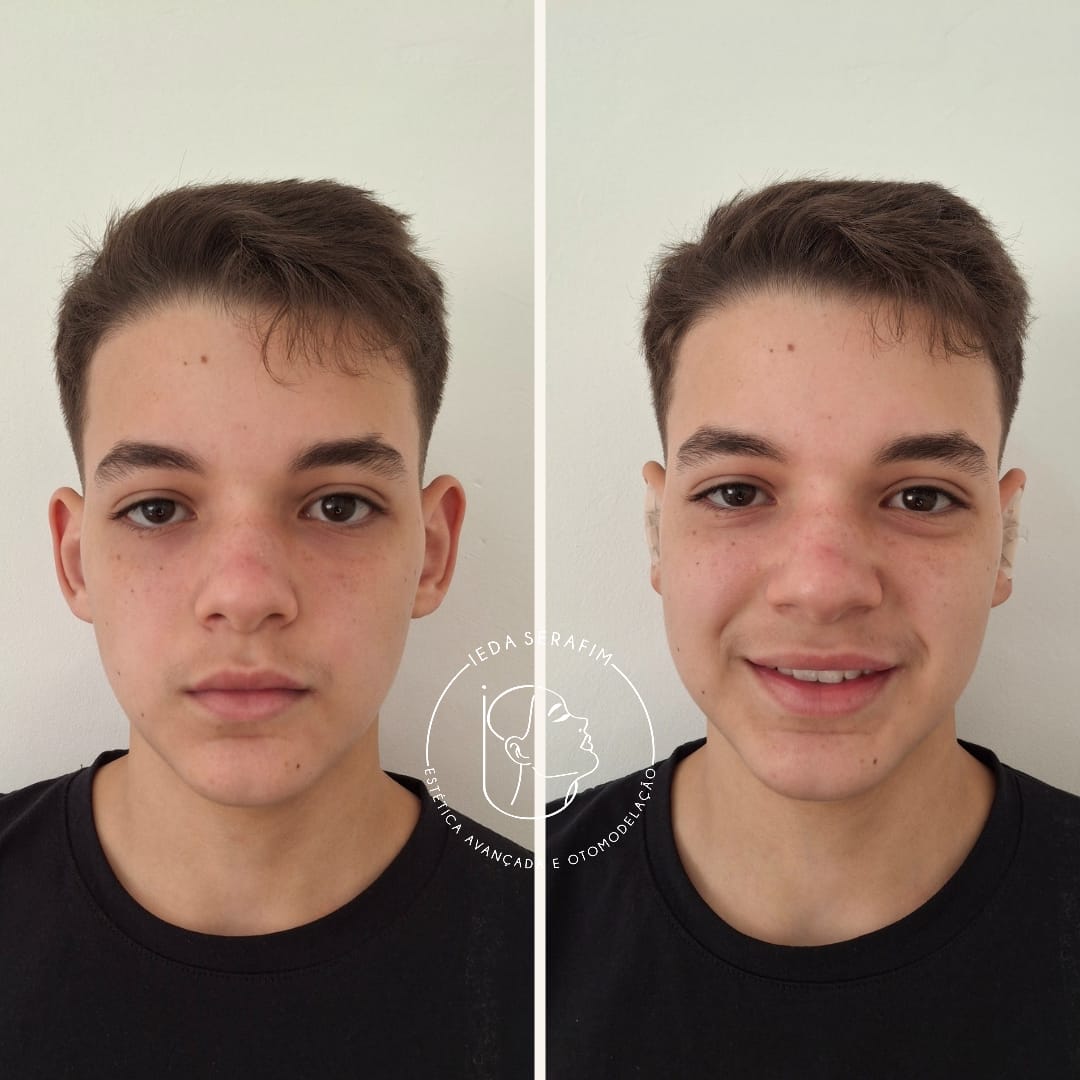 Antes e depois de otomodelação — resultado 8