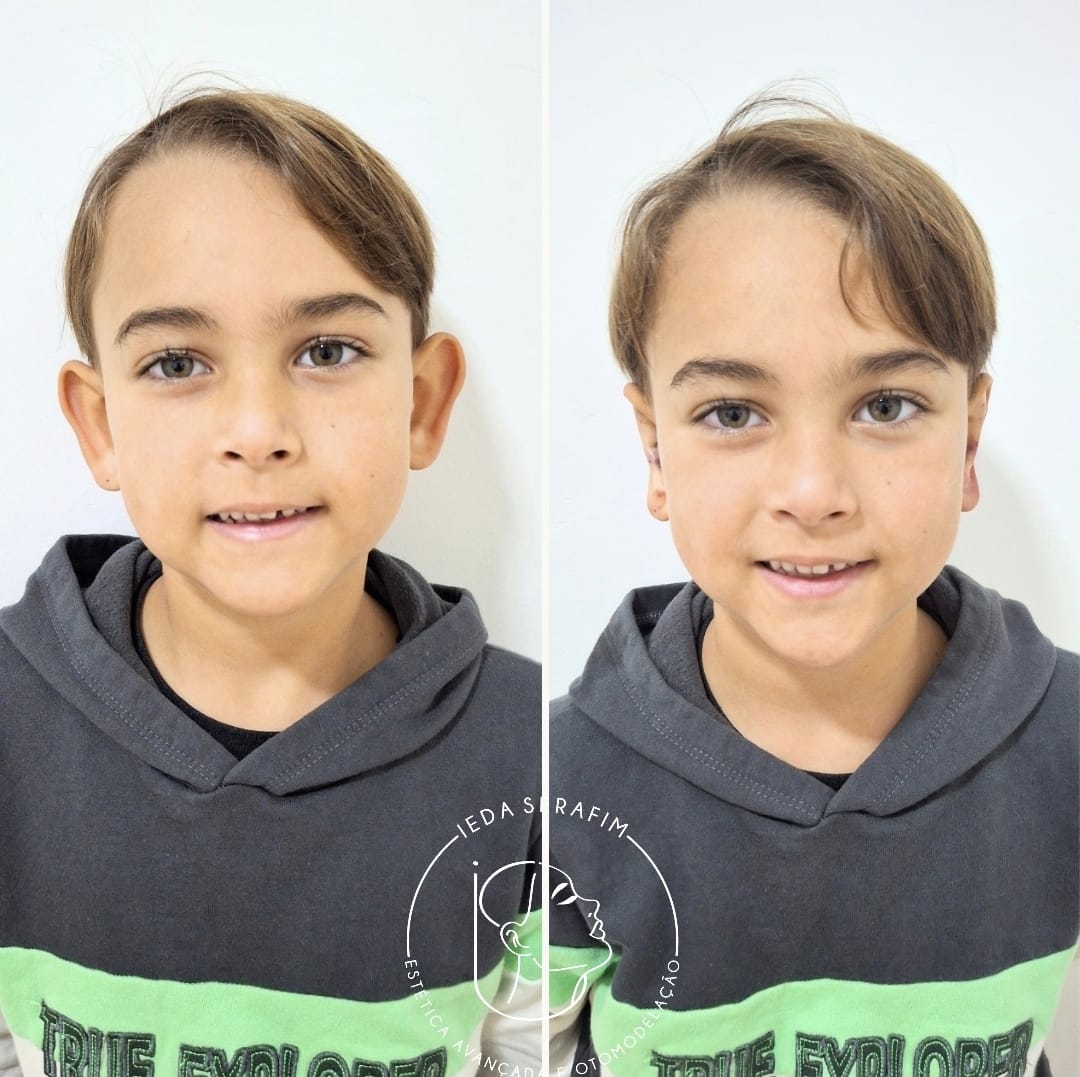 Antes e depois de otomodelação — resultado 9