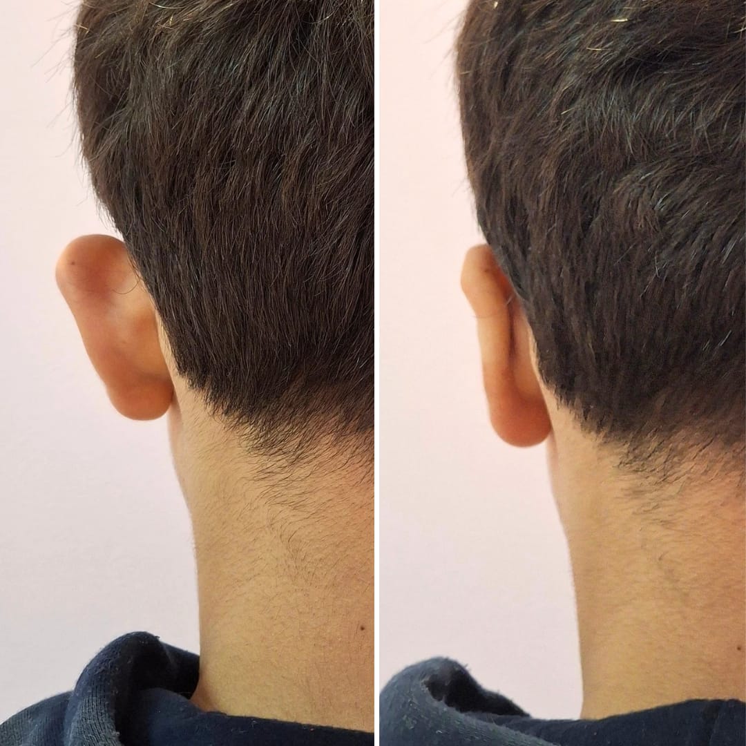 Antes e depois de otomodelação — resultado 10