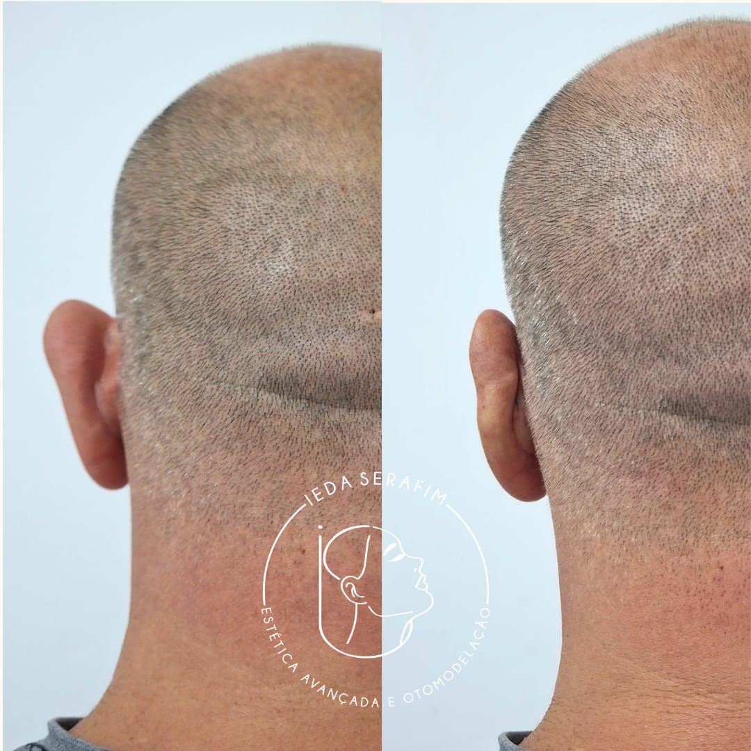 Antes e depois de otomodelação — resultado 11