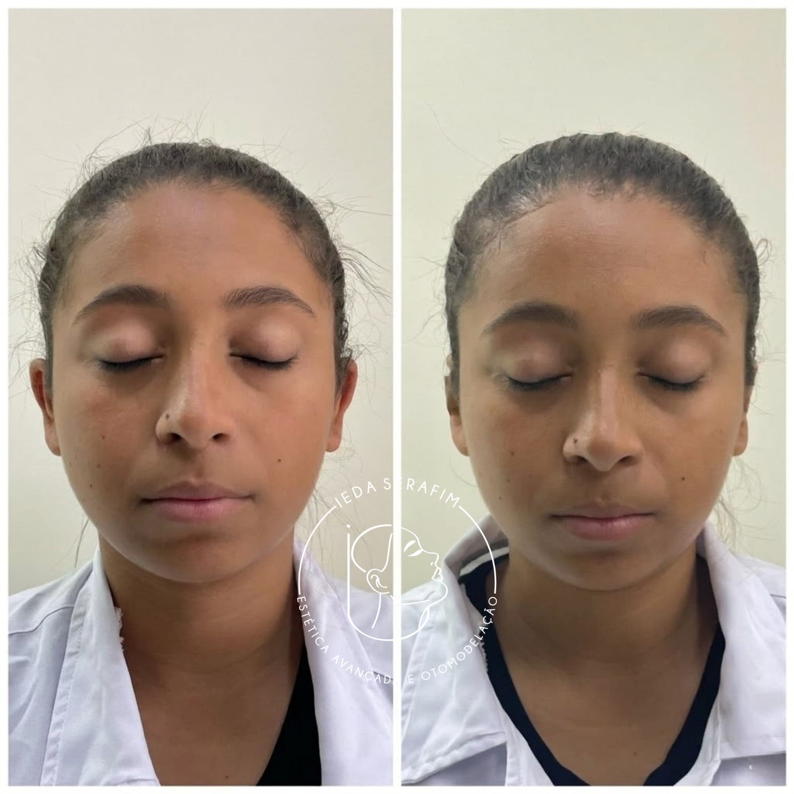 Antes e depois de otomodelação — resultado 12
