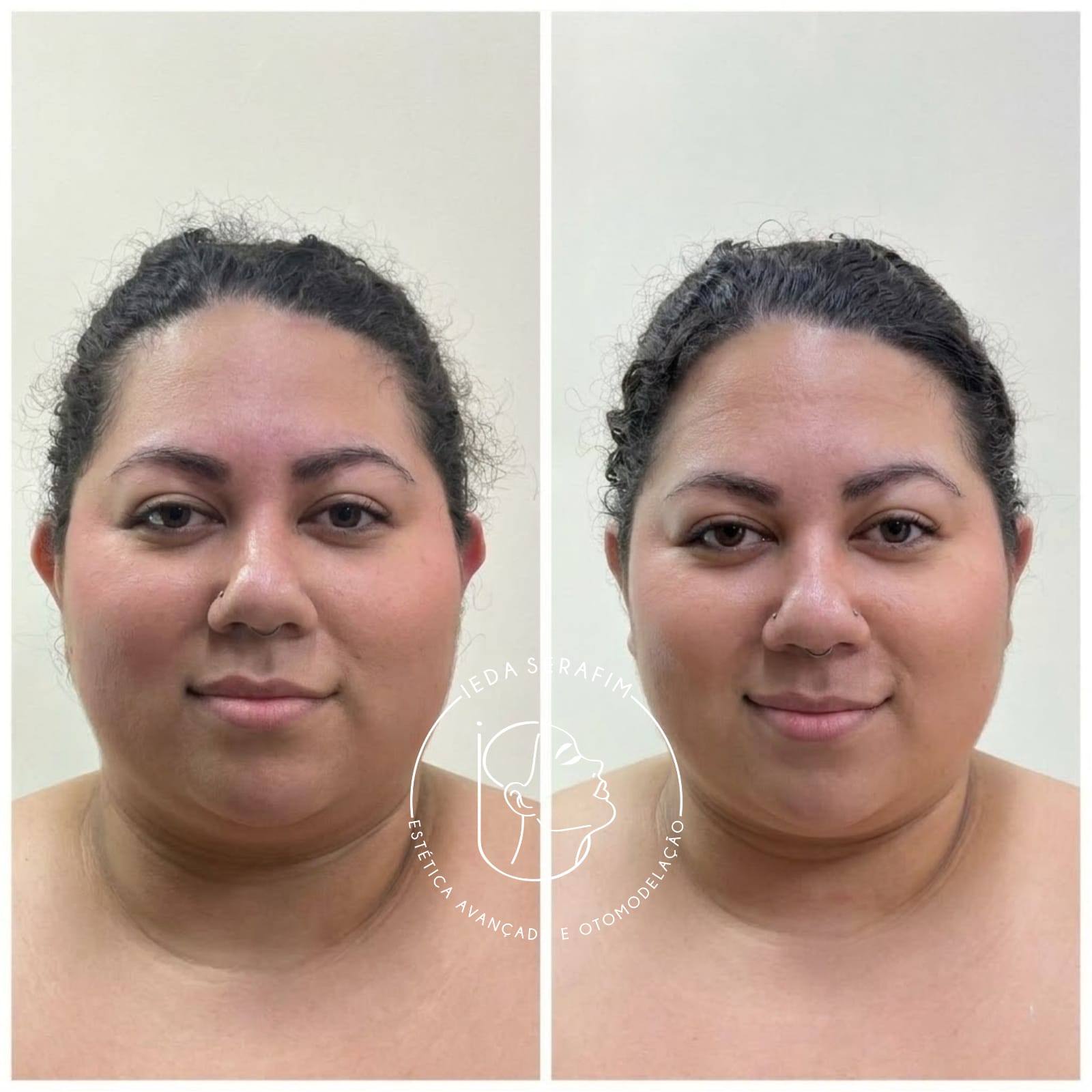 Antes e depois de otomodelação — resultado 13