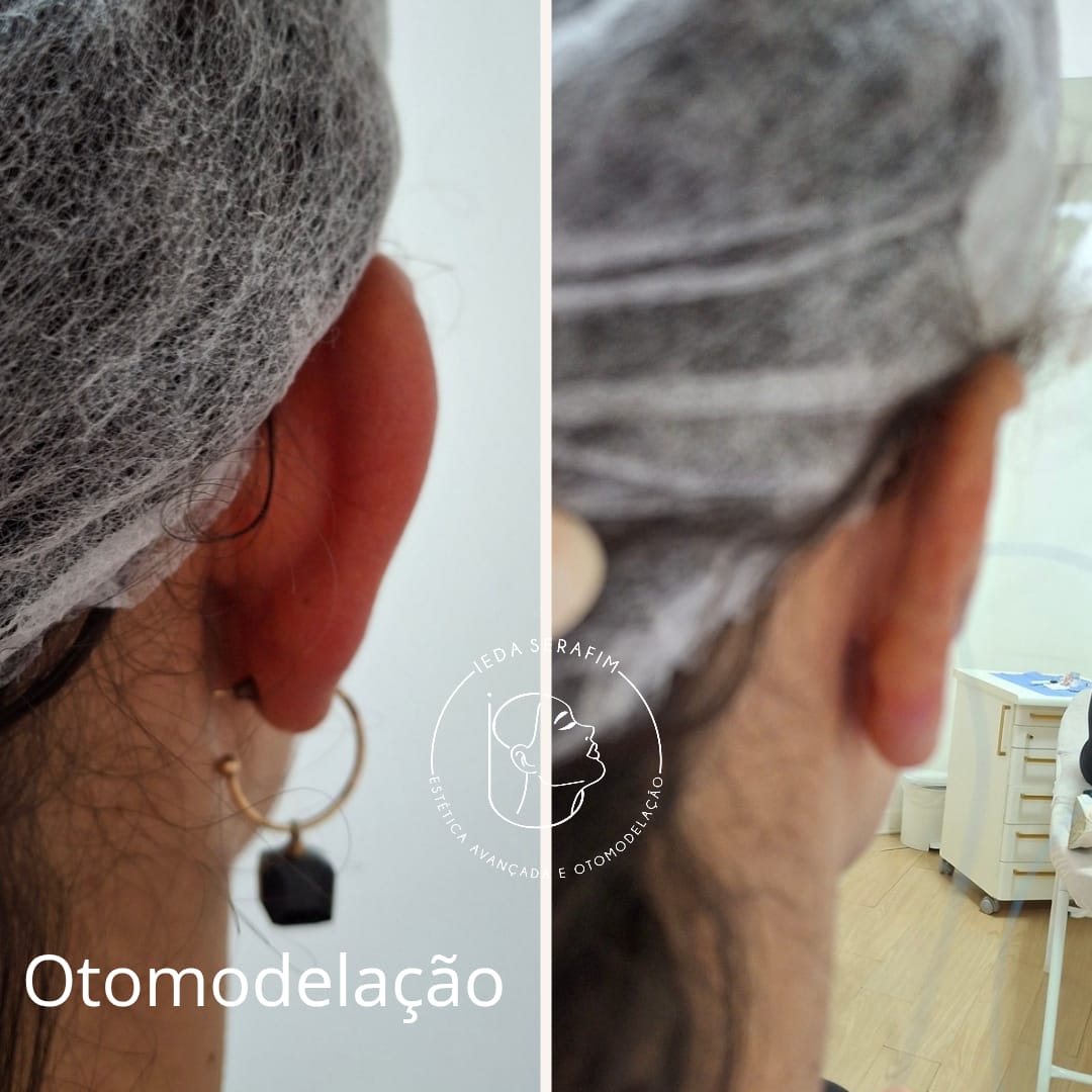 Antes e depois de otomodelação — resultado 14