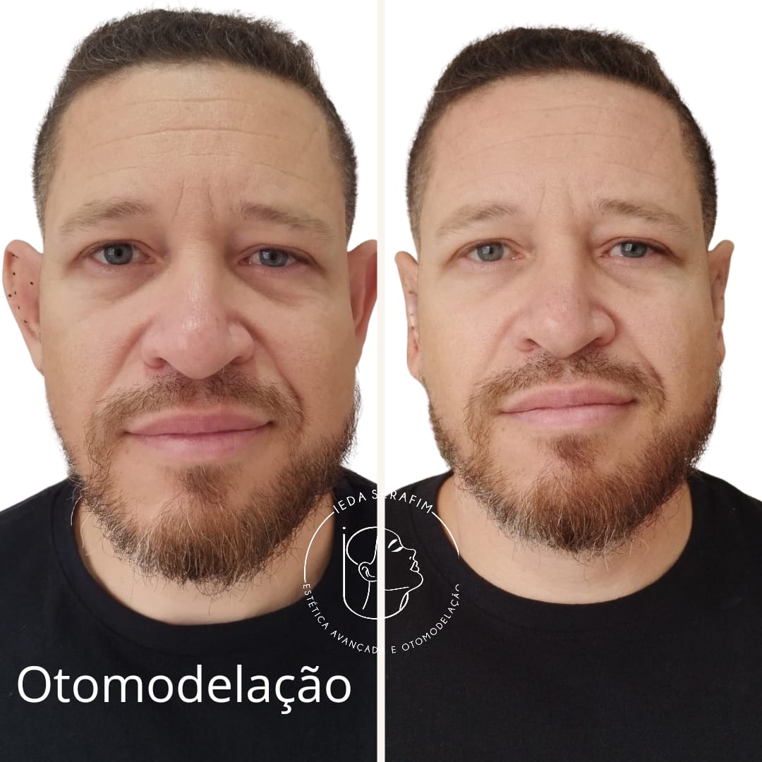 Antes e depois de otomodelação — resultado 15